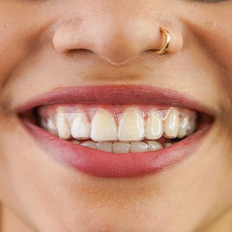 Woman smiling while wearing clear aligner