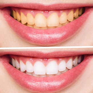 Factors that affect the cost of teeth whitening include the level of stains present