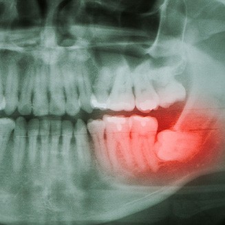 A dental X-ray that highlights an impacted wisdom tooth
