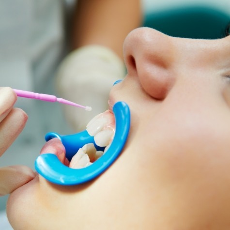 Close up of child in dental chair receiving fluoride treatment