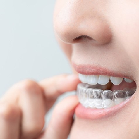 Closeup of patient putting on clear aligner