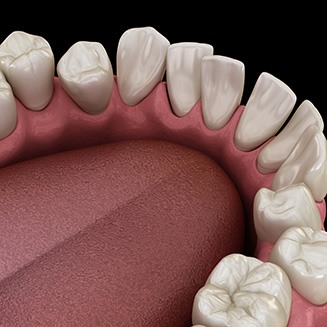 Illustration of gapped teeth