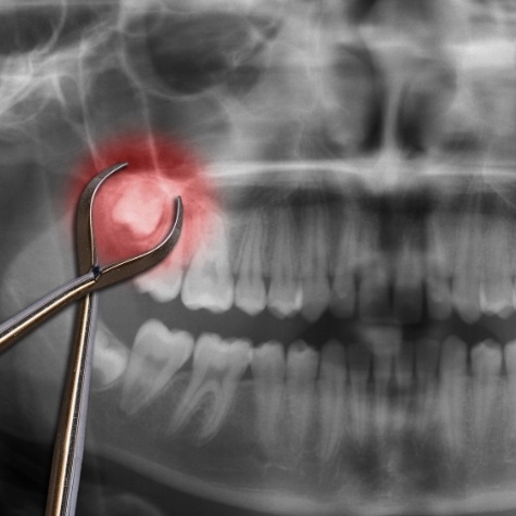 X ray of impacted wisdom tooth highlighted red